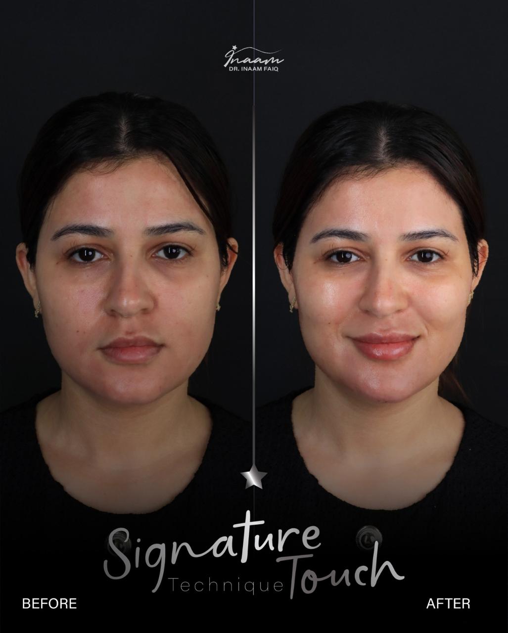 Before and after Sculptra treatment result by Dr. Inaam Faiq in Dubai