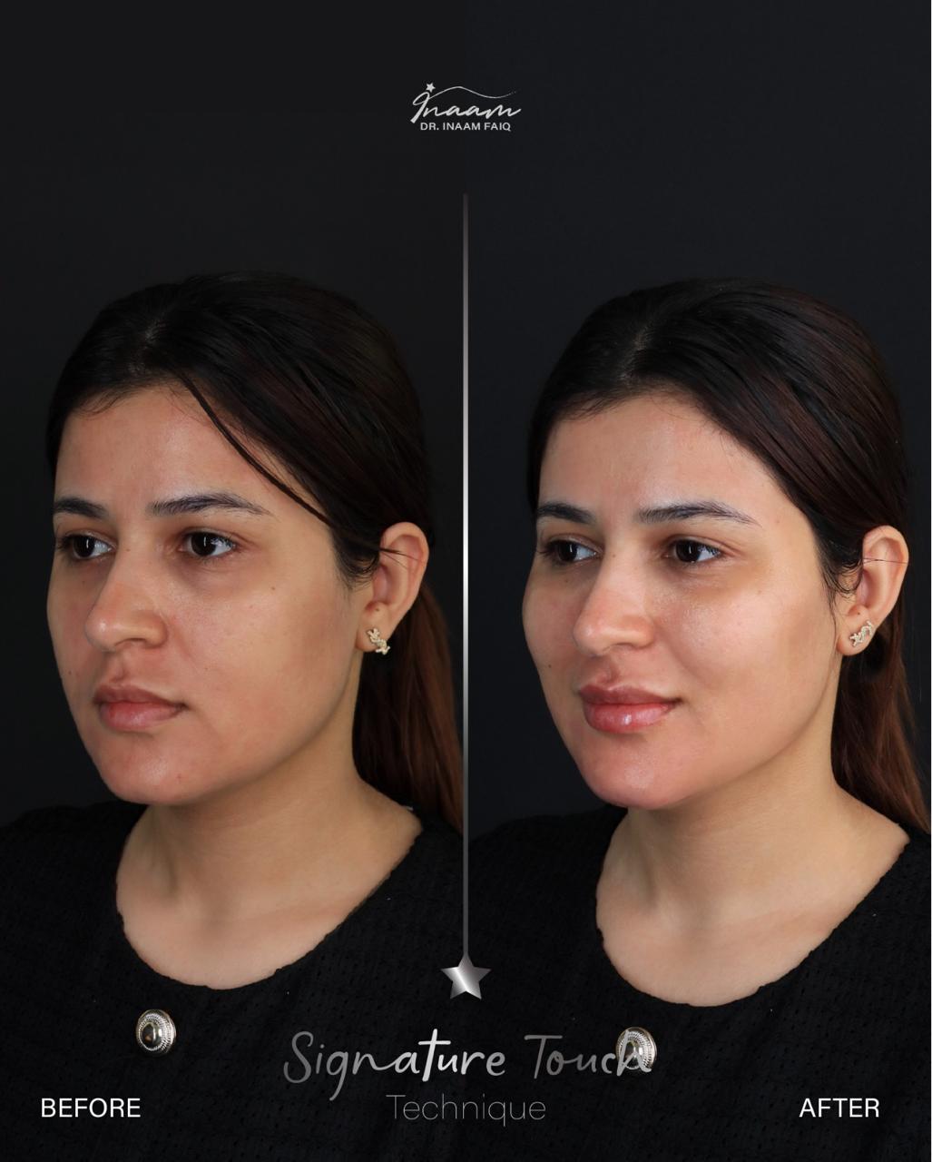 Before and after Acne Treatment treatment result by Dr. Inaam Faiq in Dubai