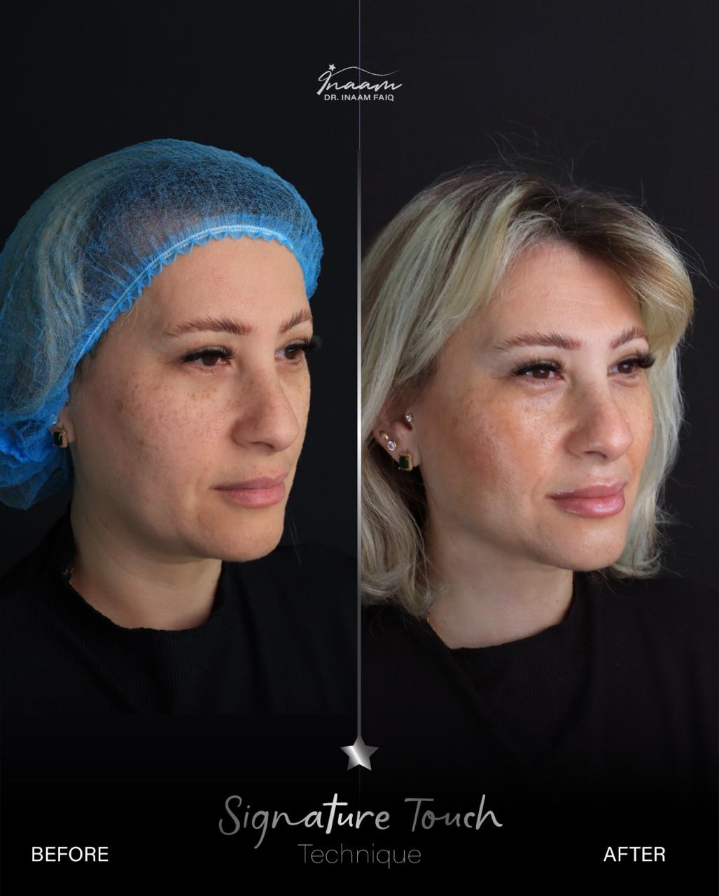 Before and after Sculptra treatment result by Dr. Inaam Faiq in Dubai