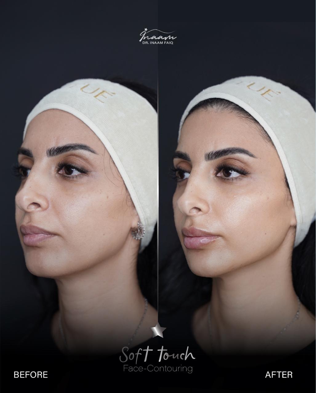 Before and after CO2 Laser treatment result by Dr. Inaam Faiq in Dubai