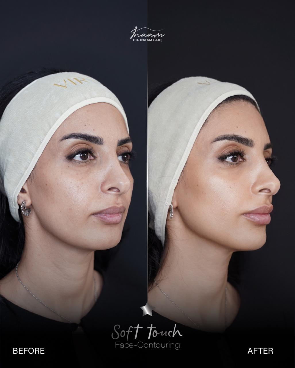 Before and after CO2 Laser treatment result by Dr. Inaam Faiq in Dubai