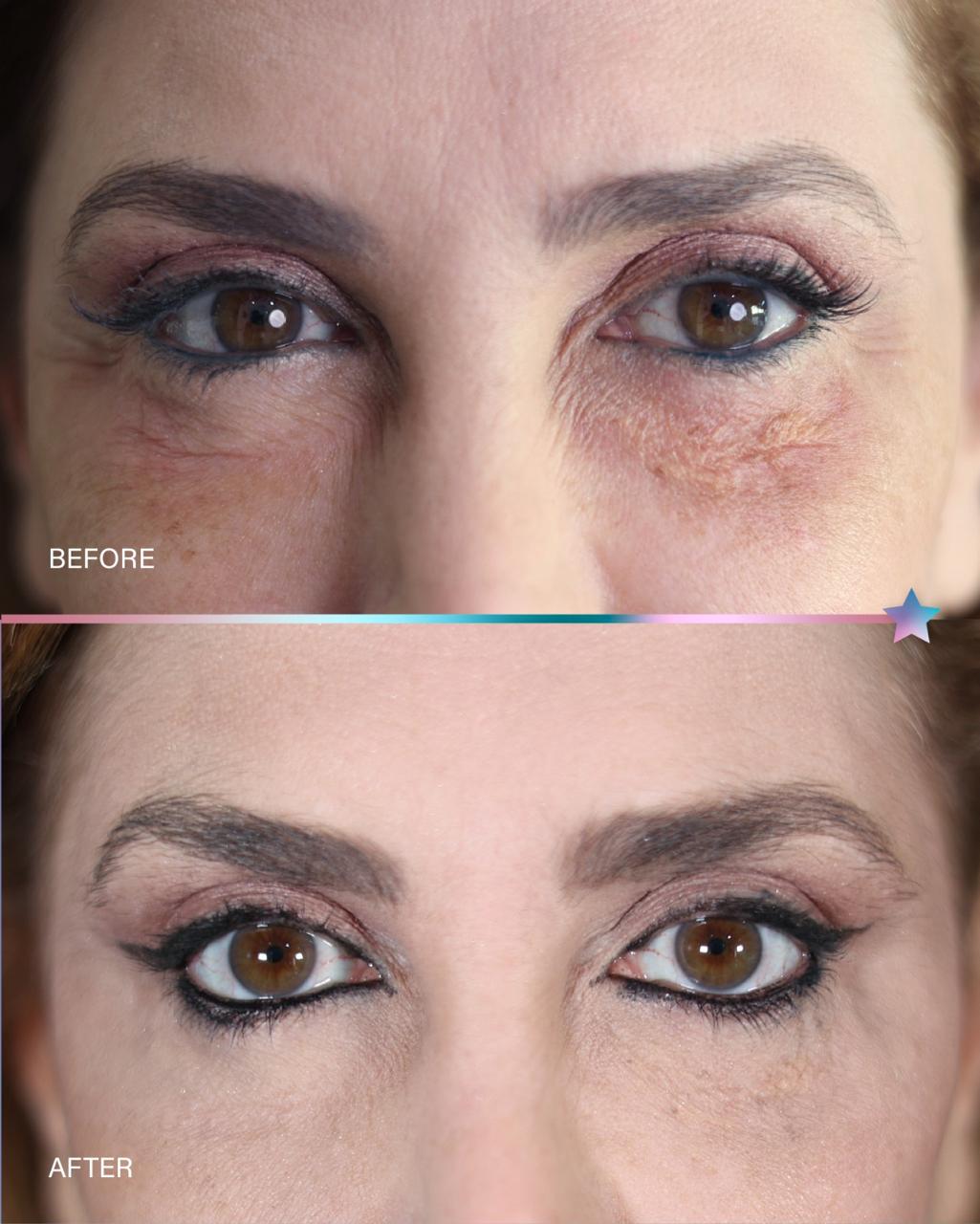 Before and after CO2 Laser treatment result by Dr. Inaam Faiq in Dubai