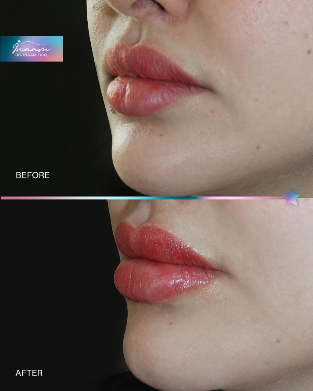 Before and after Sculptra treatment result by Dr. Inaam Faiq in Dubai