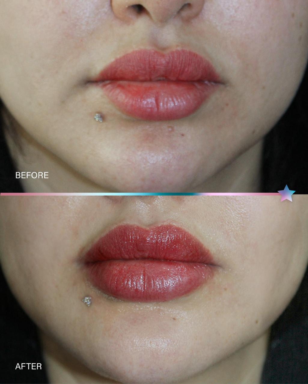 Before and after Dermapen treatment result by Dr. Inaam Faiq in Dubai
