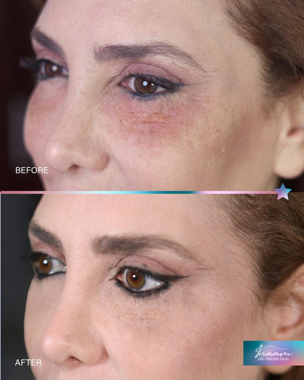 Before and after Sculptra treatment result by Dr. Inaam Faiq in Dubai