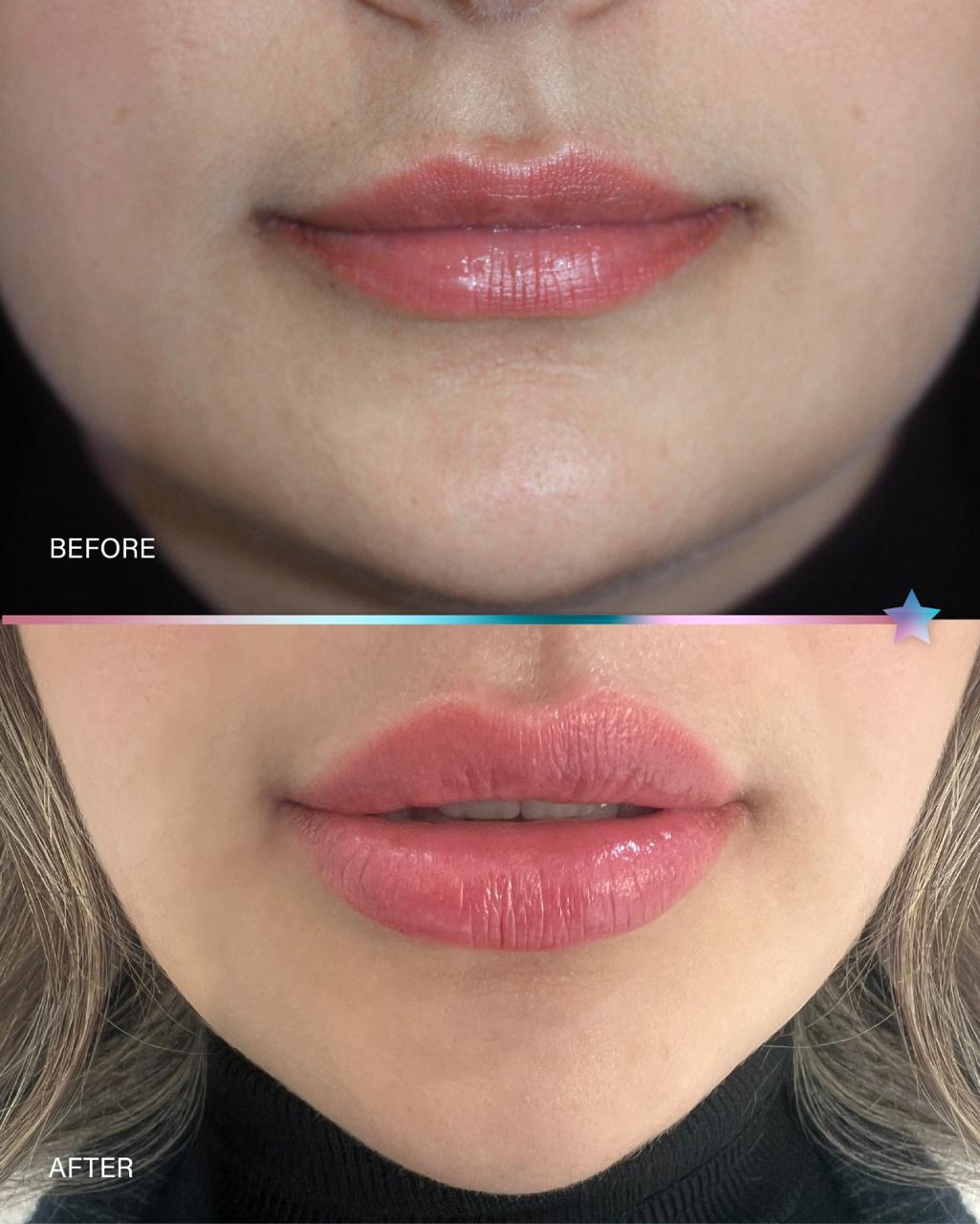 Before and after Acne Treatment treatment result by Dr. Inaam Faiq in Dubai
