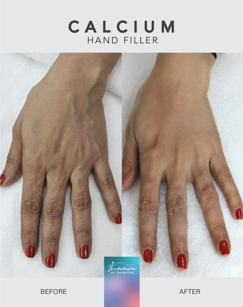 Before and after Sculptra treatment result by Dr. Inaam Faiq in Dubai