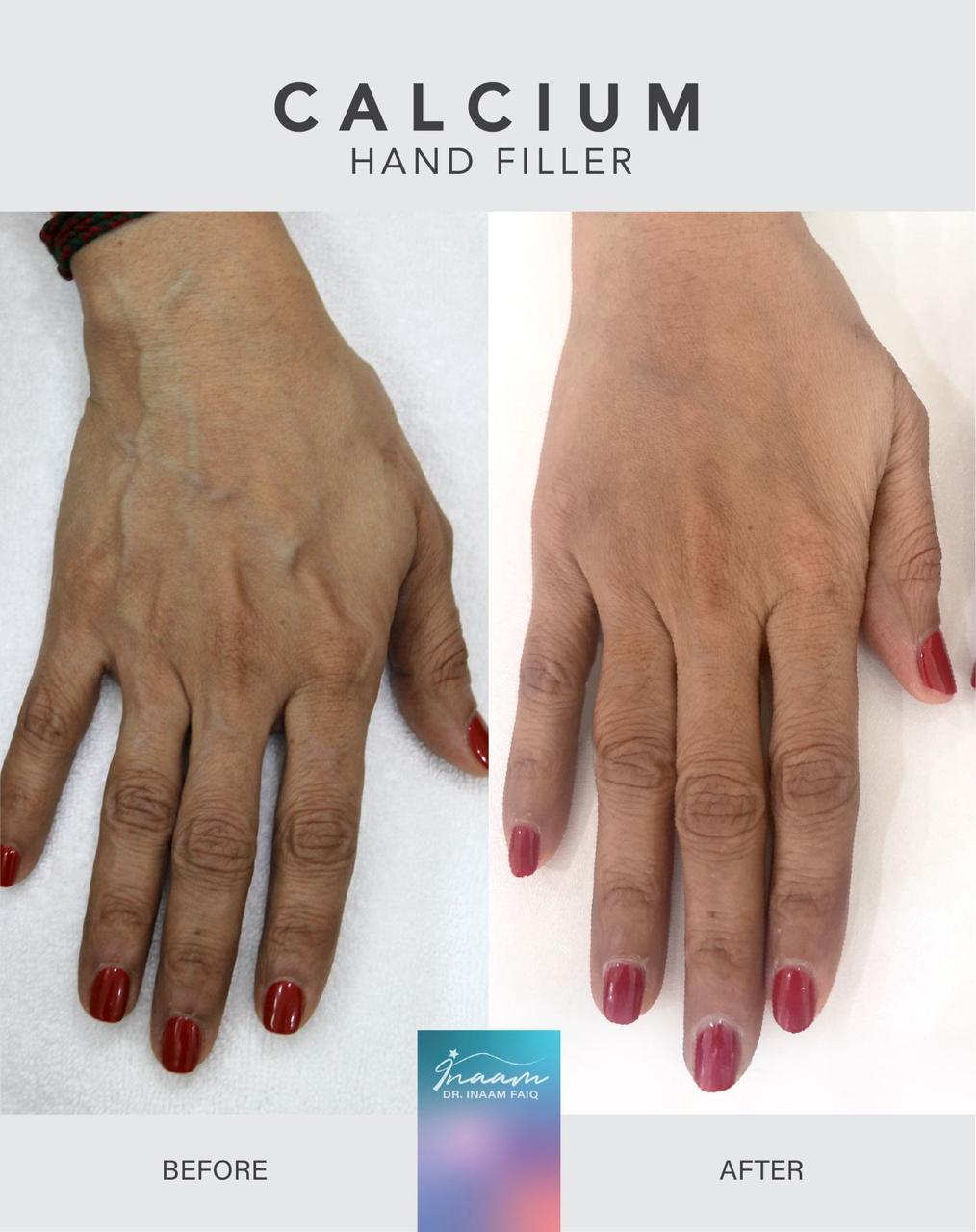 Before and after CO2 Laser treatment result by Dr. Inaam Faiq in Dubai