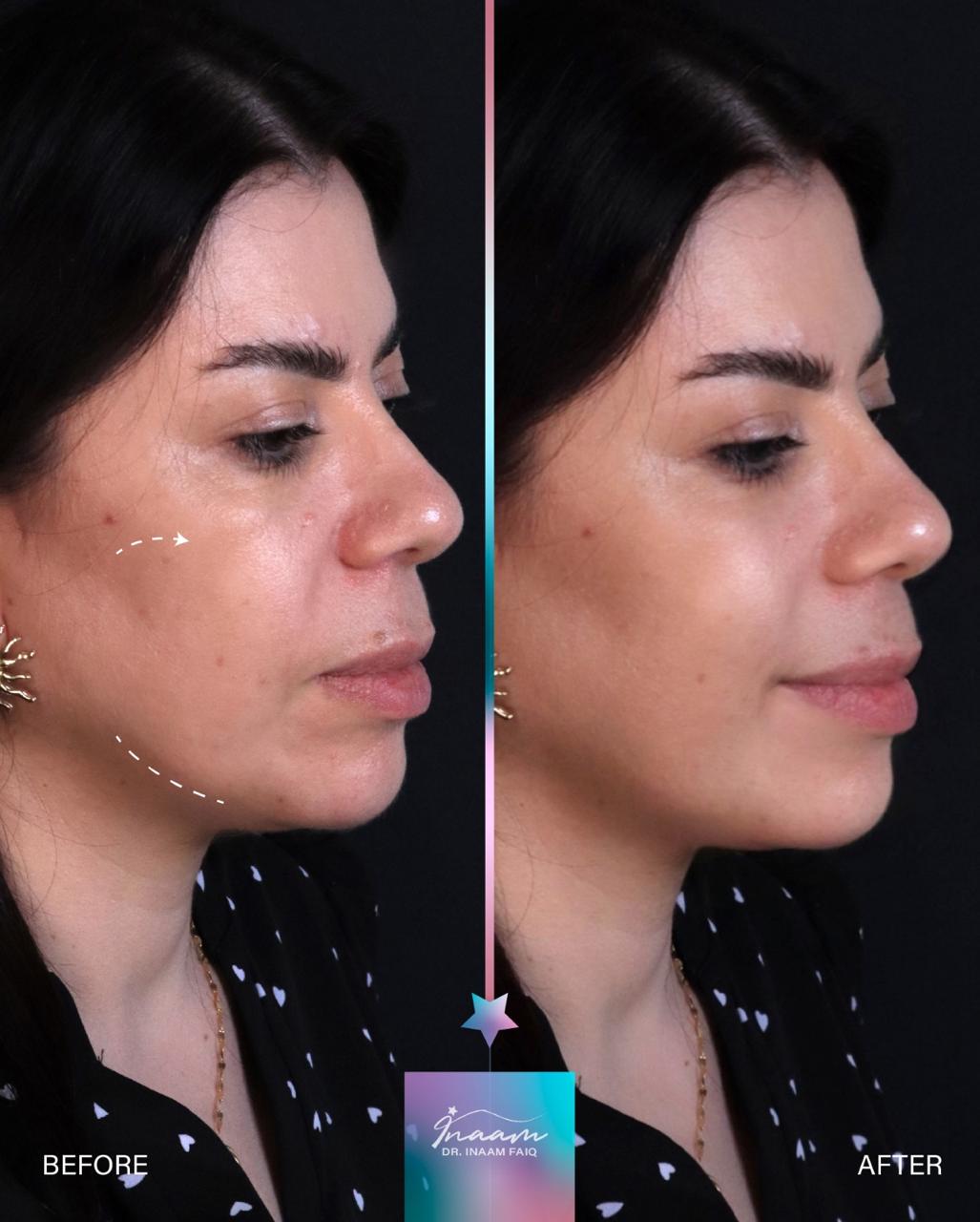 Before and after CO2 Laser treatment result by Dr. Inaam Faiq in Dubai