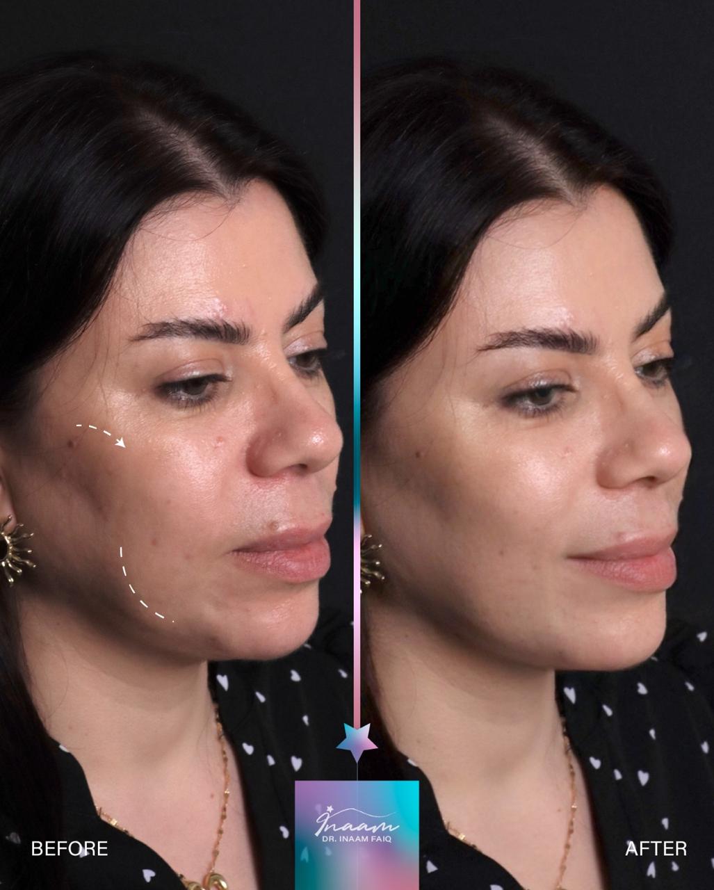 Before and after CO2 Laser treatment result by Dr. Inaam Faiq in Dubai