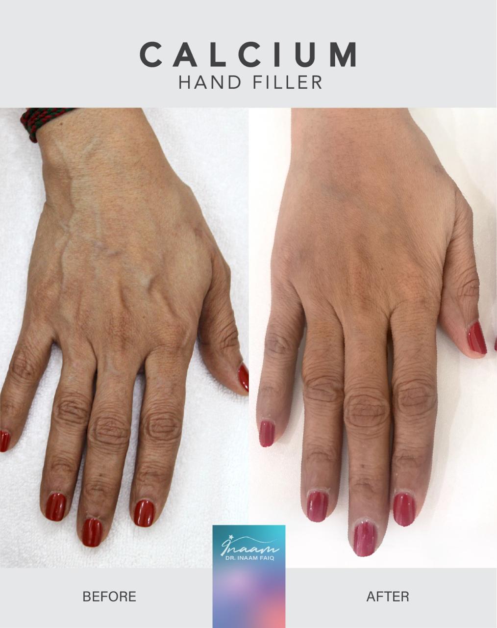 Before and after Dermapen treatment result by Dr. Inaam Faiq in Dubai