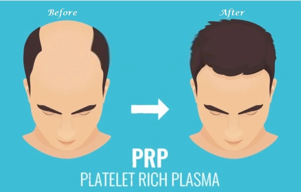 before and after prp process