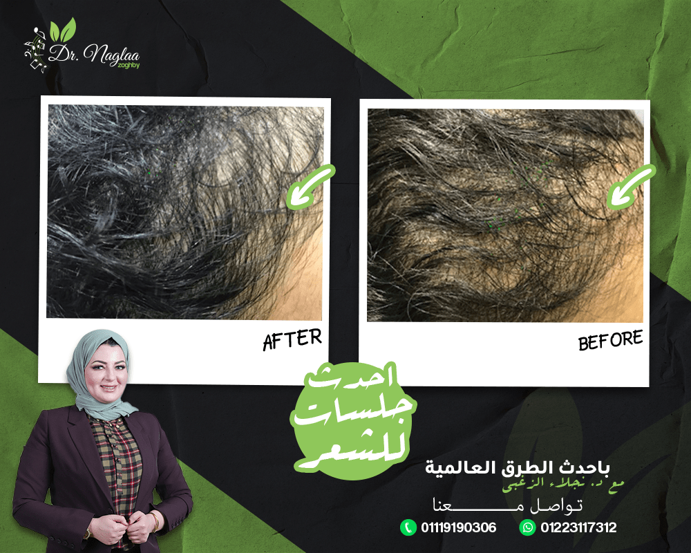 · عادة، ينشط الجهاز العصبي غدد العرق عند ارتفاع درجة . Ø­ÙÙ Ø§ÙØ¨ÙØªÙØ³ ÙÙØ¹Ø±Ù ÙØ¹ Ø¯ÙØªÙØ± ÙØ¬ÙØ§Ø¡ Ø§ÙØ²ØºØ¨Ù ÙØªØ®ØµØµÙ Ø§ÙØ¬ÙØ¯ÙÙ ÙØ§ÙØªØ¬ÙÙÙ