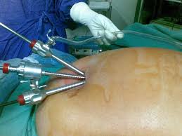 laparoscopic gall bladder surgery SILS