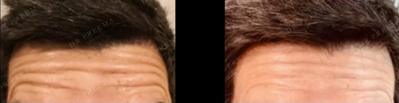 Profhilo frente antes y después mostrando líneas finas visiblemente reducidas y una piel más suave.