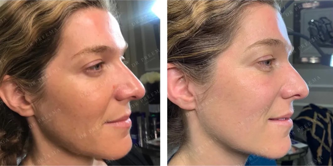 Resultados de antes y después de Profhilo en la parte inferior del rostro, mostrando una textura de piel más suave, líneas finas reducidas y firmeza mejorada.