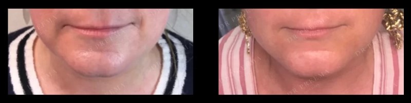 Tratamiento Profhilo para la parte inferior del rostro antes y después, mostrando una piel más tersa alrededor de la mandíbula y una textura mejorada.