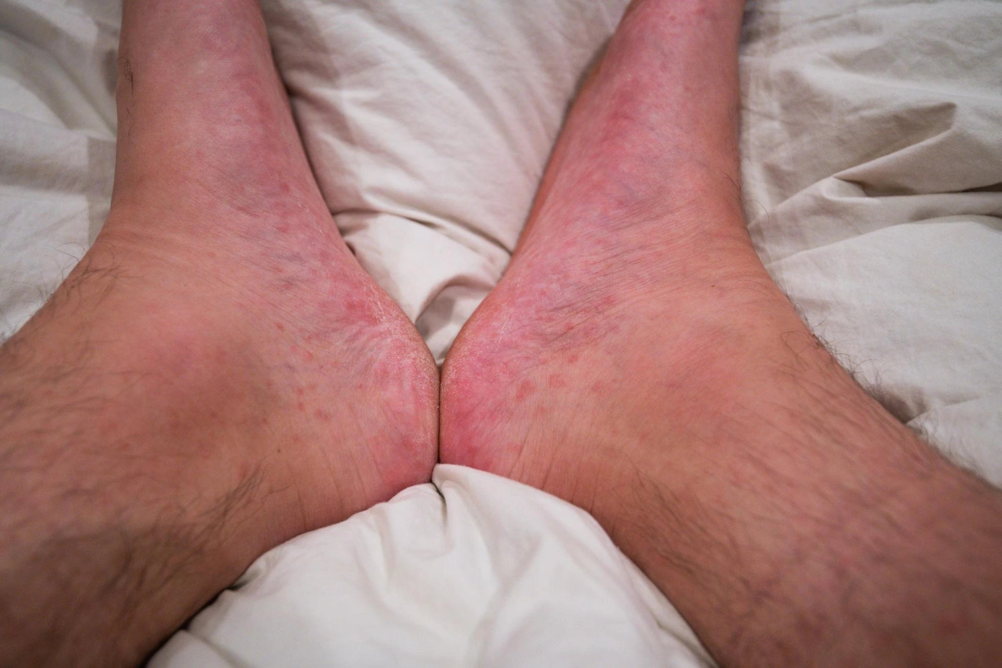 Foot Rash & Sole Symptoms