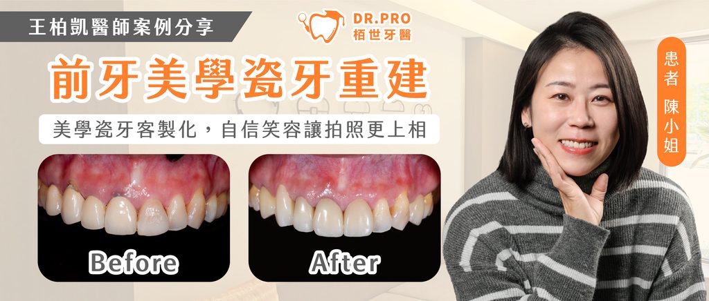 前牙舊假牙與牙齦狀況案例照片