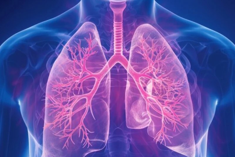 Bronchiectasis