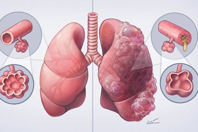 COPD