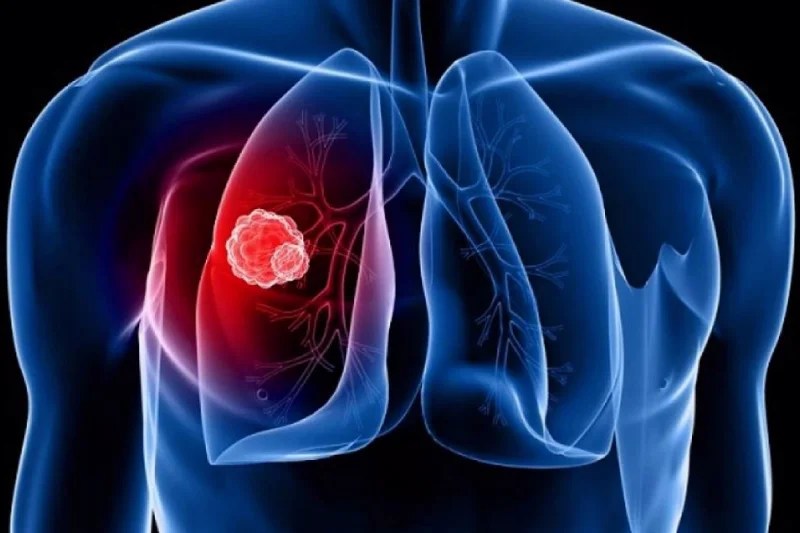 Lung Cancer