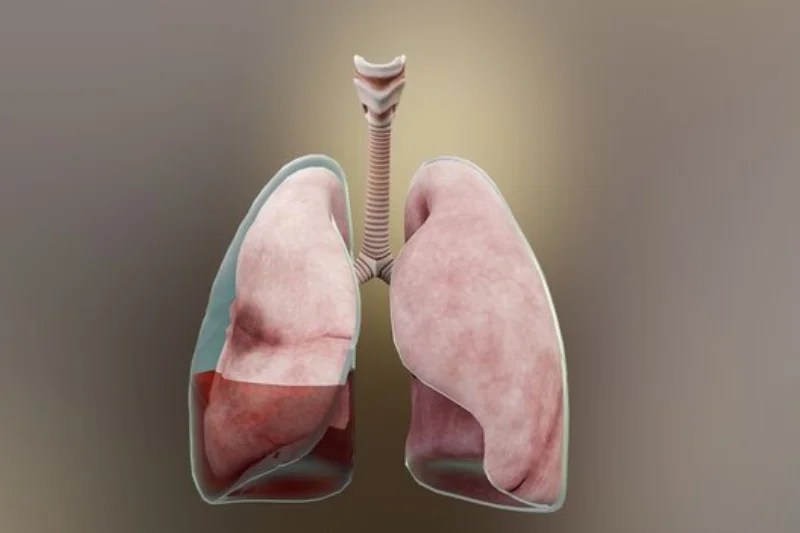 Pleural Effusion