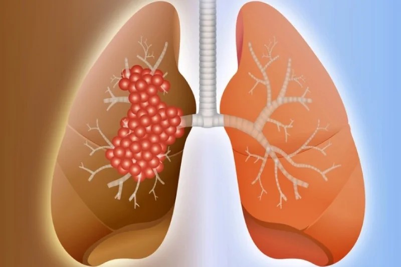 Pulmonary Fibrosis