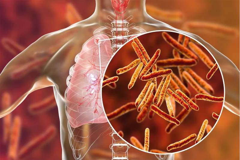 Tuberculosis (TB)