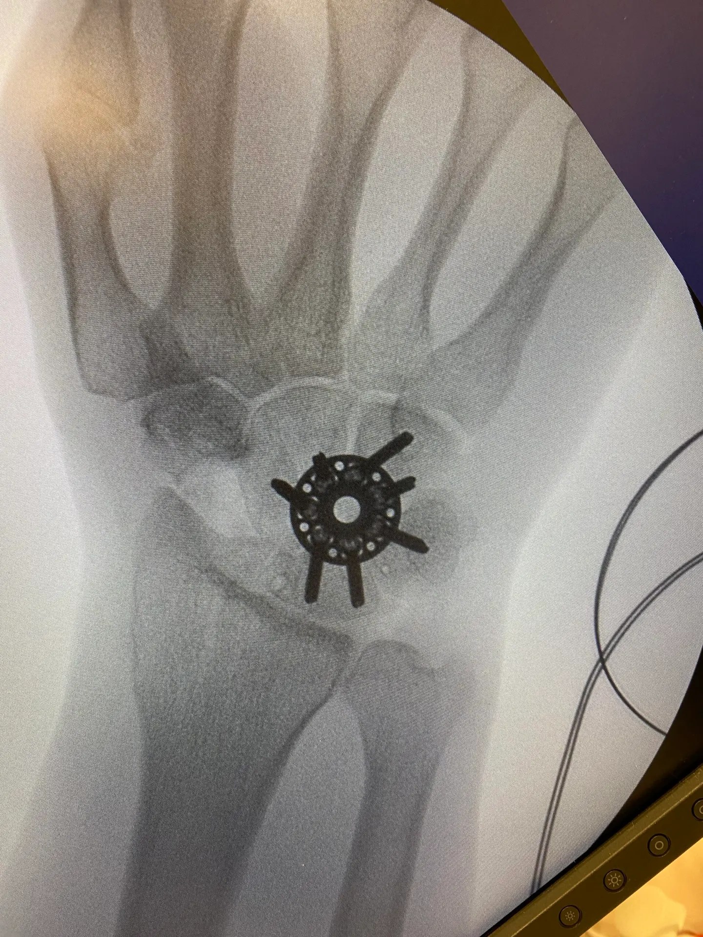 Xray of hand and wrist illustrating hand surgery procedures