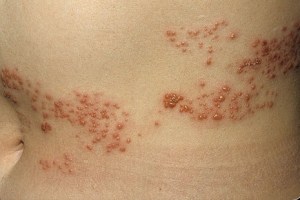 Herpes Zoster di leher sebelah kiri