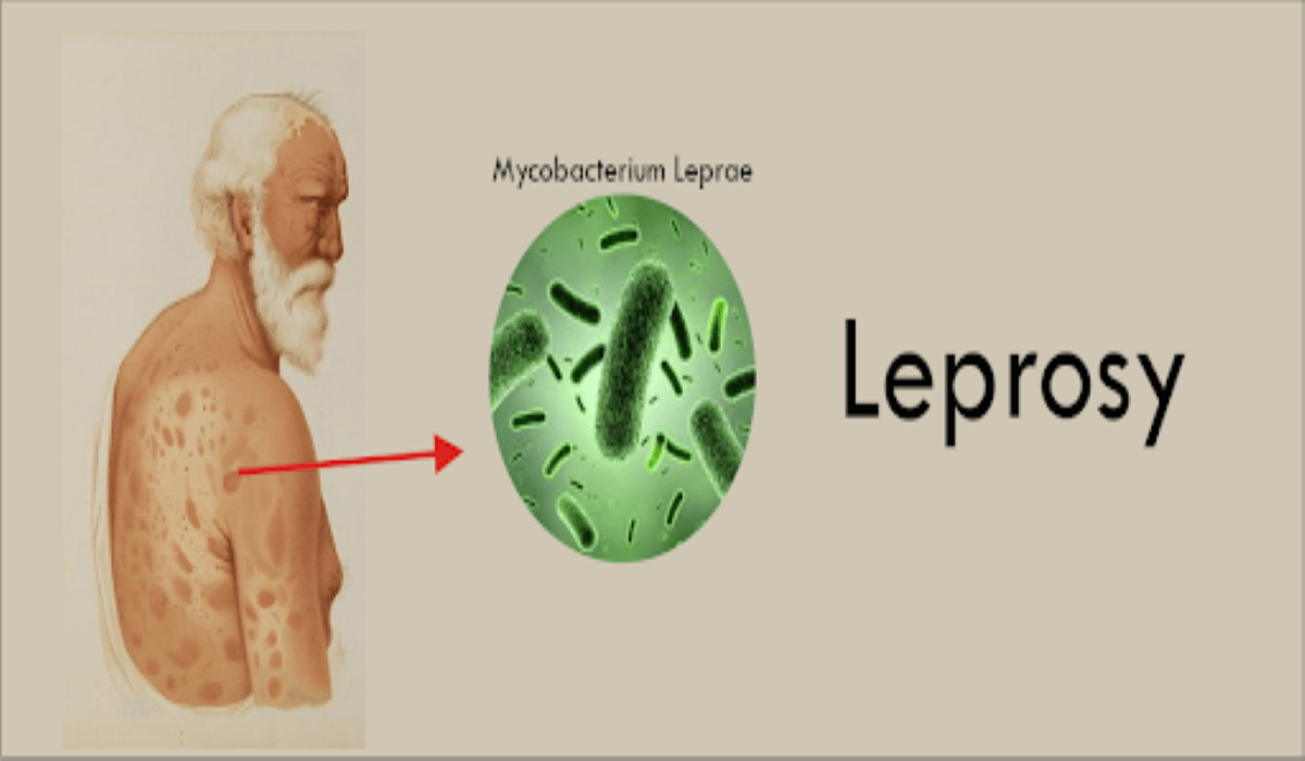 True! Leprosy spreads through respiratory droplets and face masks help curb its spread