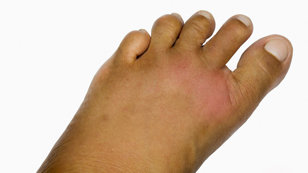 No evidence child’s severe skin condition caused by insect bite