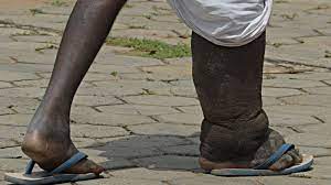 How mosquitoes contribute to spread of elephantiasis