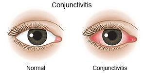 Ṣe itọ ni won fi n se ìtọ́jú ojú pipọn, conjunctivitis?
