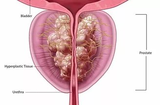 Rezum bph procedure in toronto