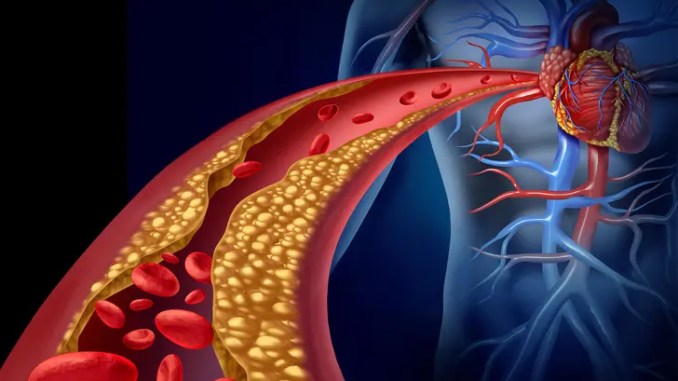 1800ss_thinkstock_rf_heart_disease
