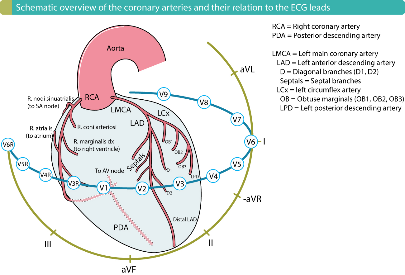 Learn what causes coronary artery disease (cad) and how it is diagnosed. Ecg Localization Of Myocardial Infarction Ischemia And Coronary Artery Occlusion Culprit Ecg Echo