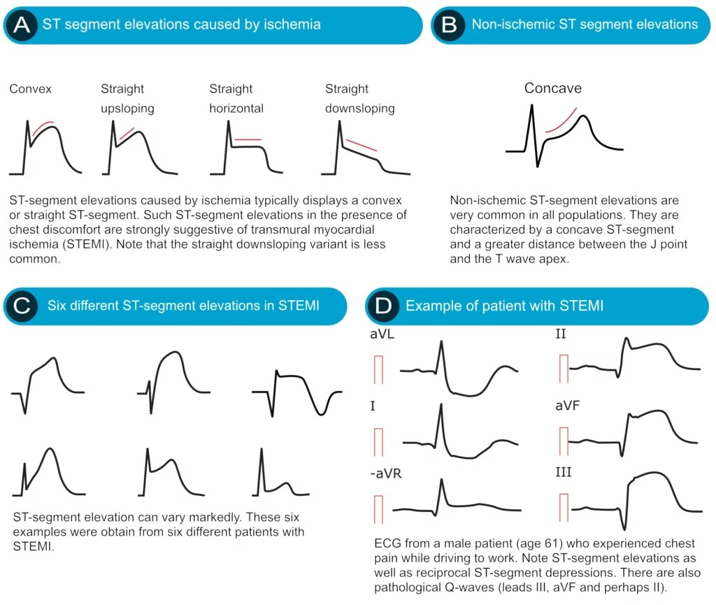 Concave vs convex ecg