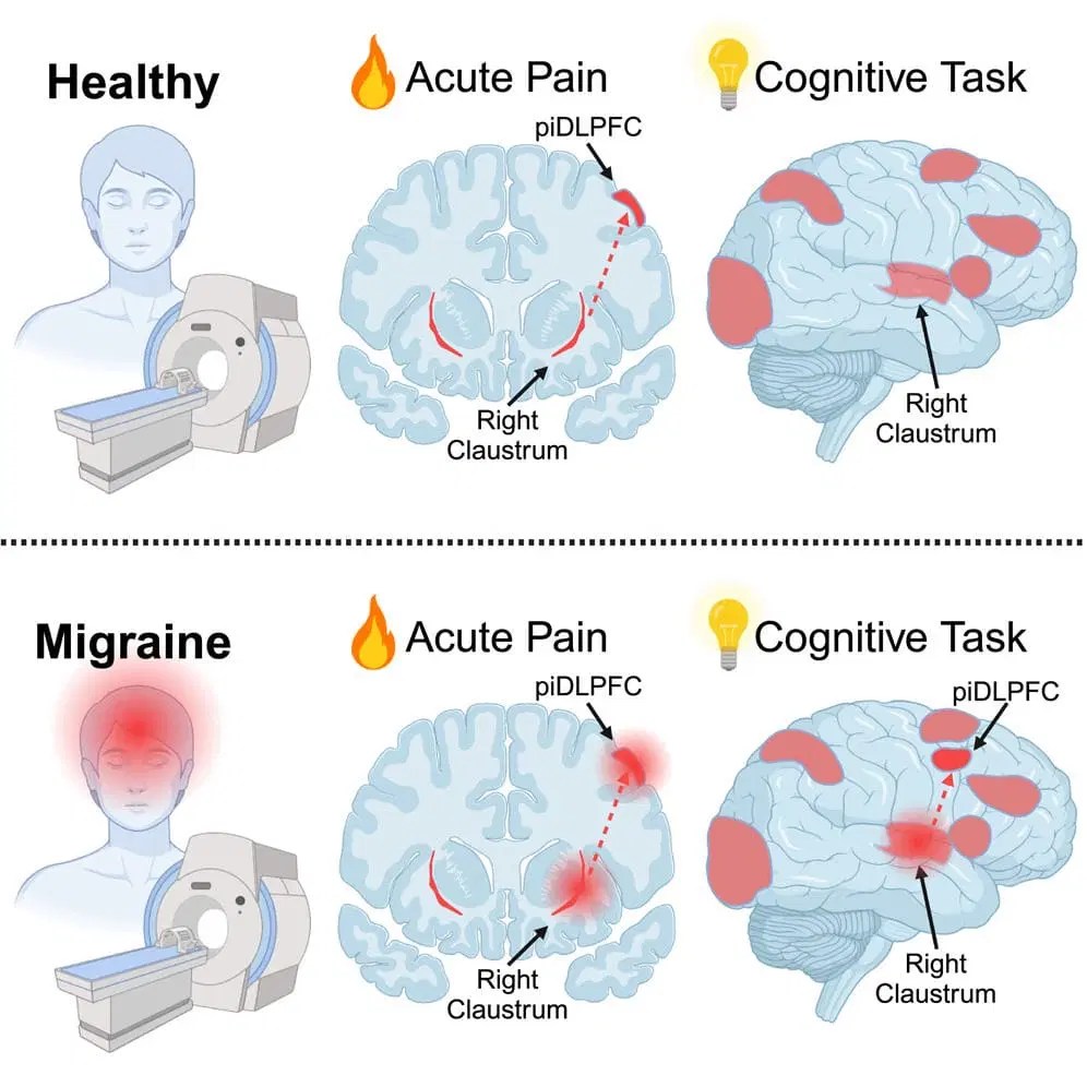 Pdf Cognitive Dysfunction And Migraine - Best Nature Pictures in HD