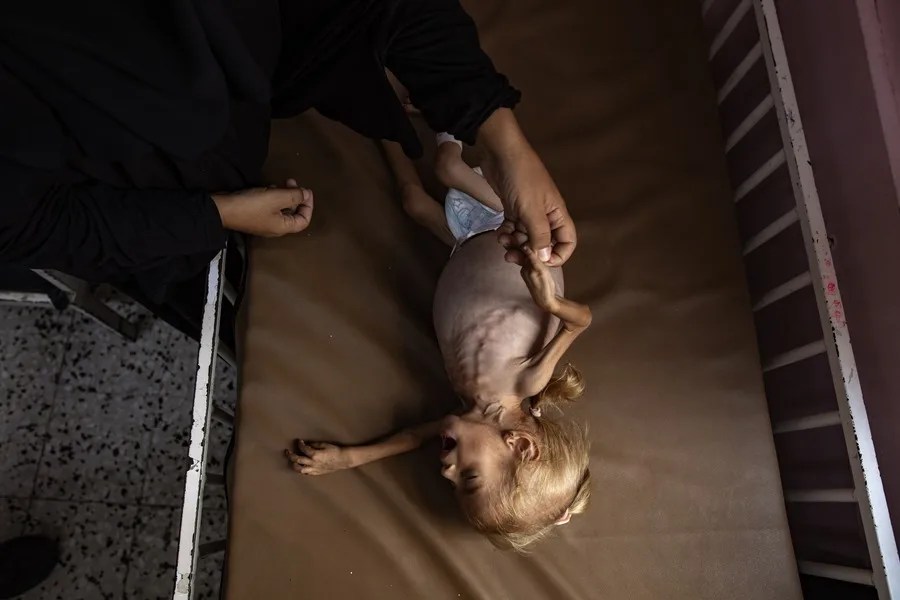 Sham Qudeih, una niña palestina de dos años, yace en una cama del Hospital Nasser de Khan Younis, al sur de la Franja de Gaza