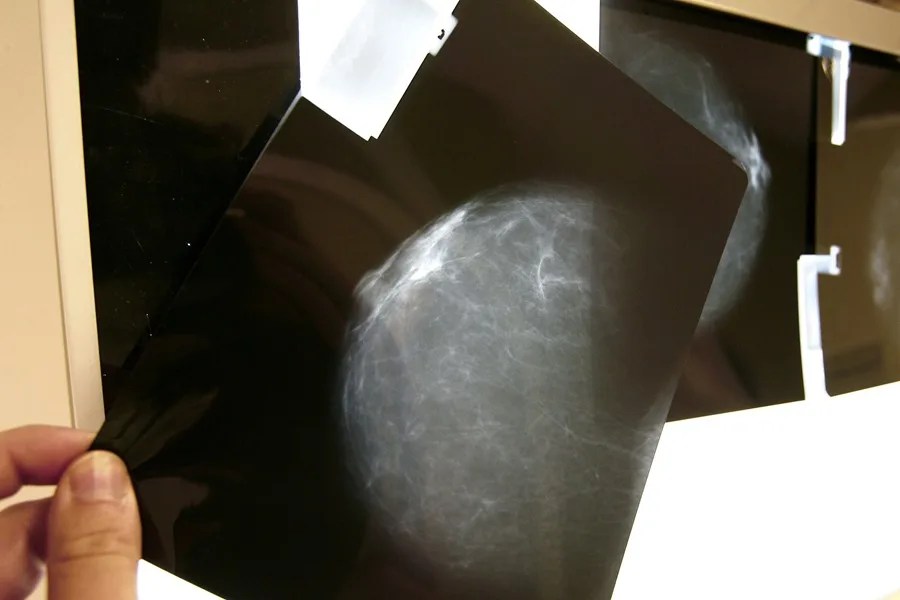 reclamaciones cáncer mama