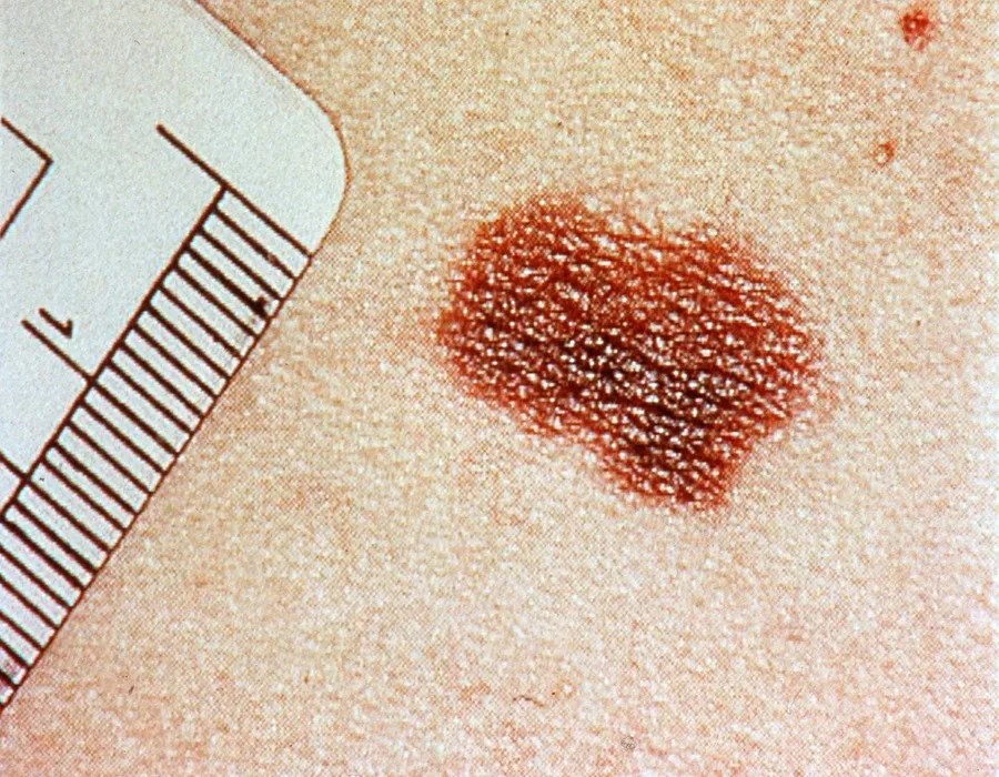 Vista de un melanoma en la piel.