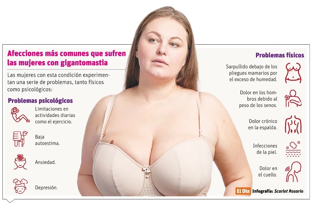 Gigantomastia, condición que afecta salubridad física y emocional de la mujer