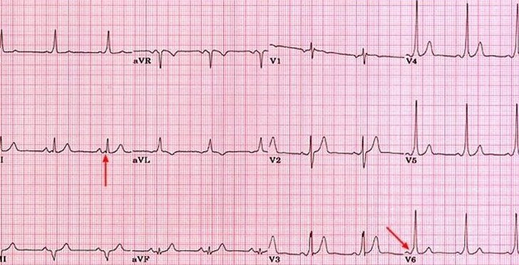 Wolff Parkinson White Syndrome Ecg Vs Normal Mstoh