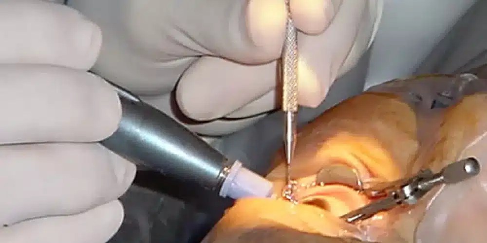 نصر ينتخب رغم جراحة العين