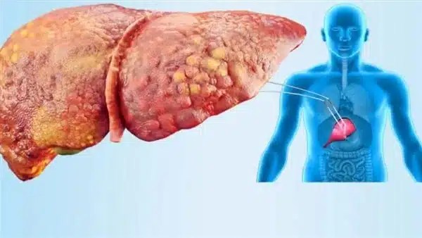 3 عادات تضر بصحة الكبد يجب تجنبها