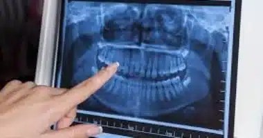 اكتشاف الأشعة السينية .. ثورة علمية غيرت الطب الحديث