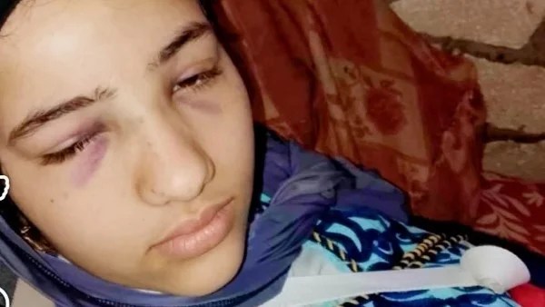 مأساة فتاة نجت من حادث ووضعت في ثلاجة الموتى