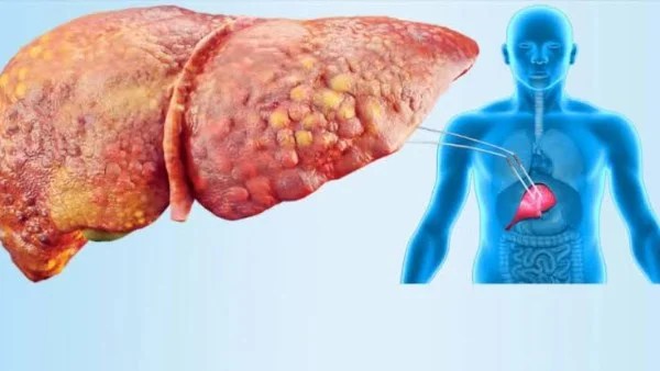 نمط الحياة وتأثيره على الكبد الدهني ومراحل ما قبل السكري